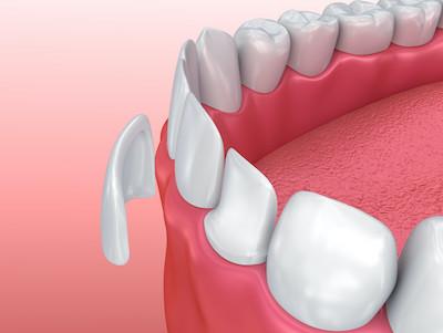 Porcelian veneers illustration in Royal Oak, MI