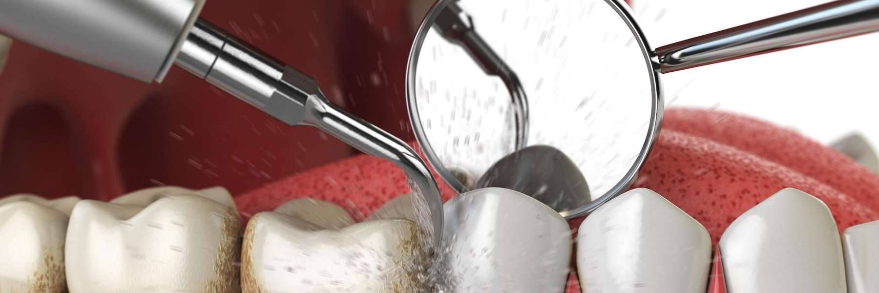 An Illustration of a Dental cleaning in Royal Oak