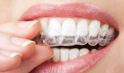 An Invisalign Retainer in Royal Oak