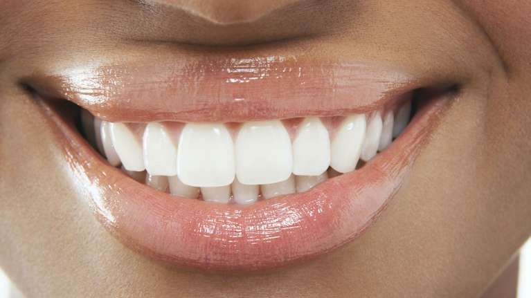 A smile after a Broken Tooth treatment in Royal Oak, MI