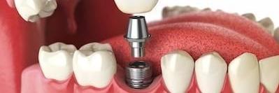 An illustration of a dental implant in Royal Oak, MI